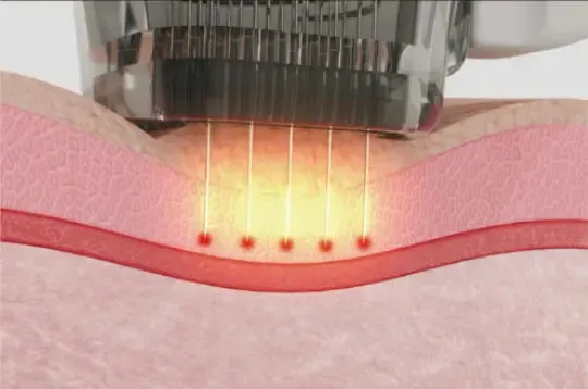 Pure Tone Inthera Bipolar RF Microneedling Machine with Cryo Cooling Technology